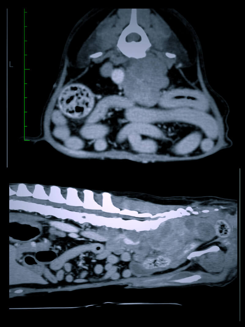 Carcinoma del sacco anale