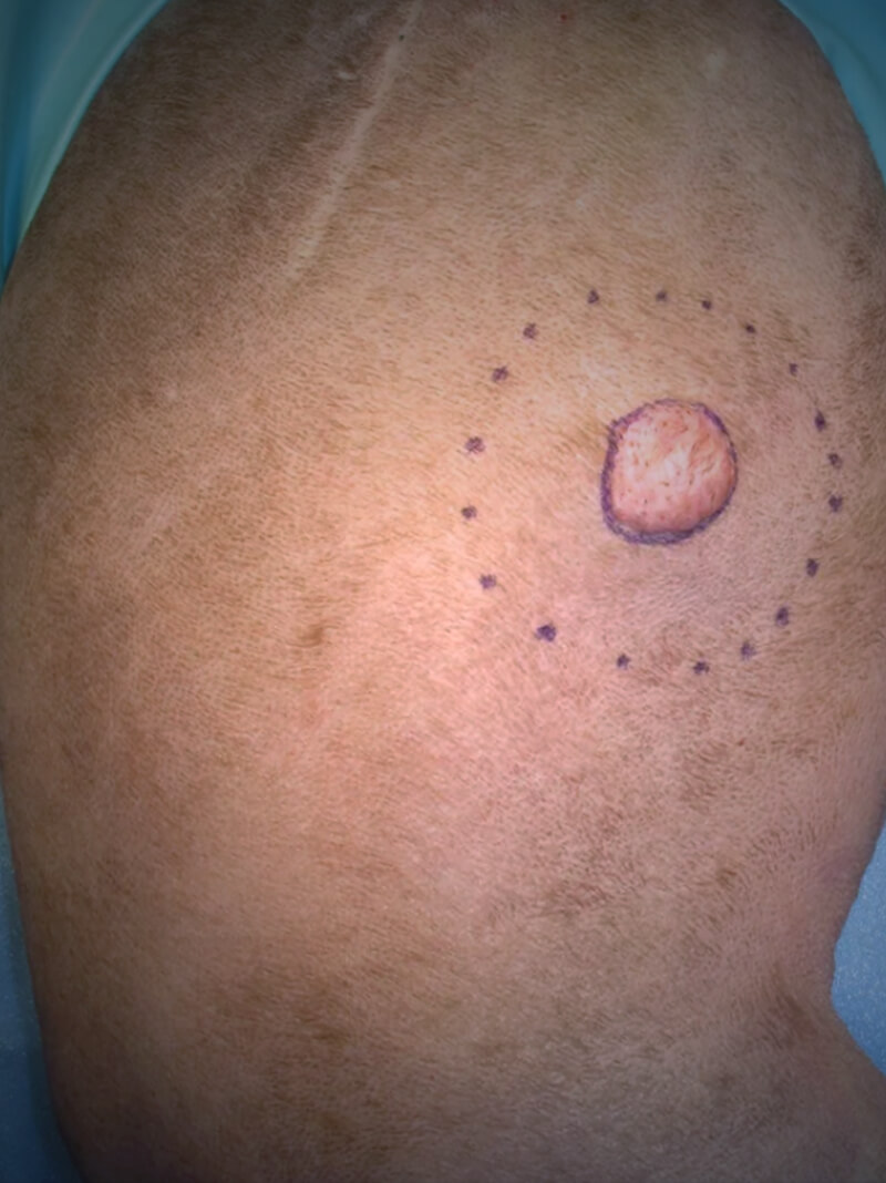MCT Mastocitoma